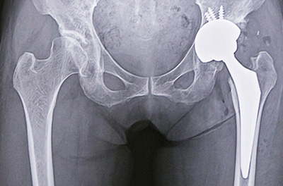 人工股関節置換術後のレントゲン