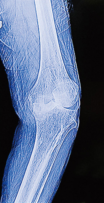 変形性膝関節症のレントゲン