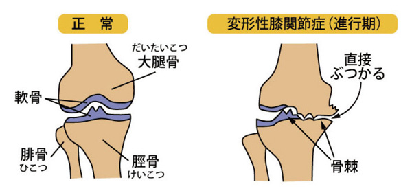 川﨑 俊樹 先生 膝の痛みの原因と保存的治療 ひざの痛み いろいろな選択肢から適切な治療法を選びましょう 人工関節ドットコム