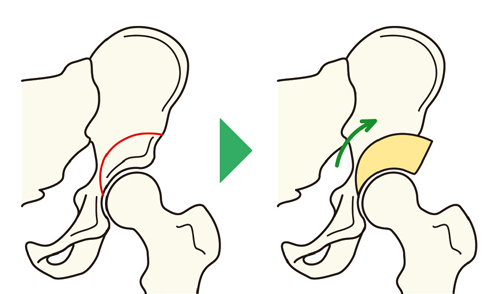 寛骨臼回転骨切り術