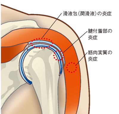 肩関節周囲炎