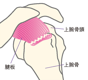 腱板断裂