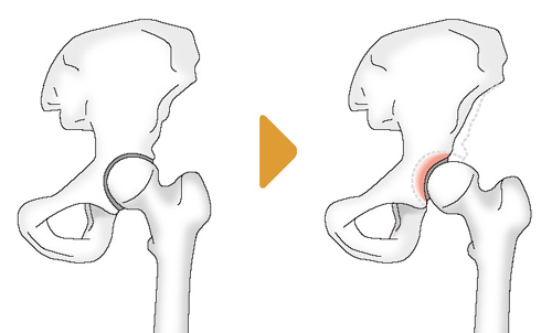 正常な股関節と寛骨臼形成不全