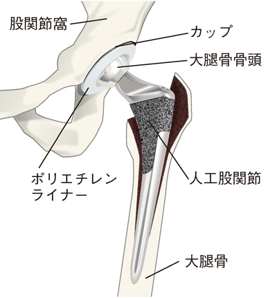人工股関節