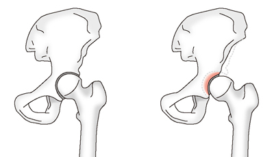 正常な股関節と臼蓋形成不全