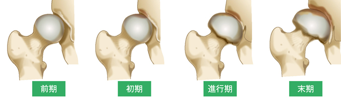 前期、初期、進行期、末期の4段階