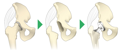 人工股関節置換術の流れ