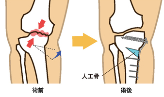 オープンウエッジ法
