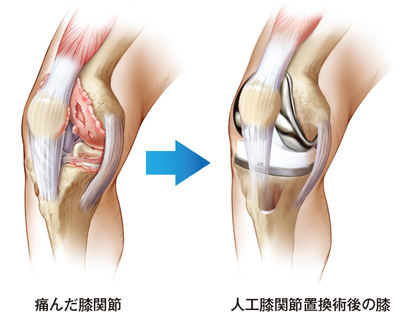 人工膝関節置換術