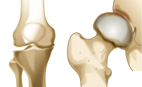 変形性膝関節症／変形性股関節症