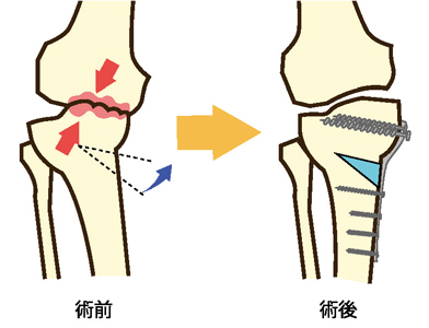 骨切り術