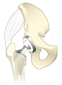 人工股関節置換術