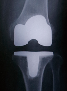 人工膝関節全置換術後のレントゲン