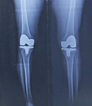 人工膝関節を入れた膝関節