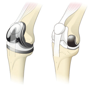 人工膝関節全置換術と部分置換術