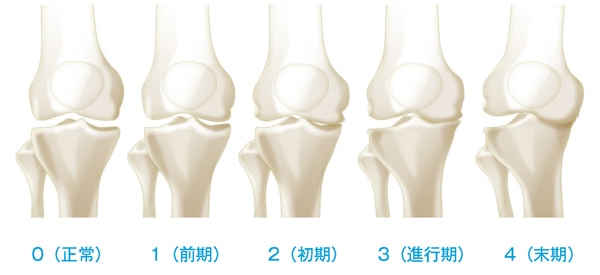 変形性膝関節症のKL分類