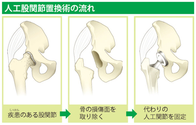 人工股関節置換術の流れ