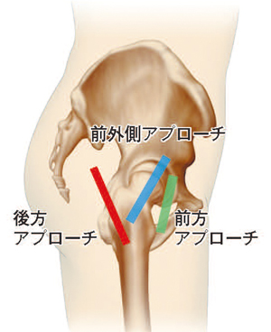 手術アプローチの種類