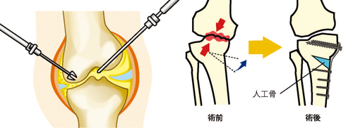 関節鏡視下手術と骨切り術