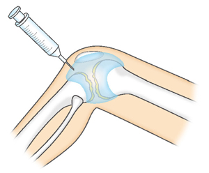 ヒアルロン酸などの関節内注射