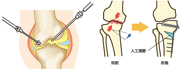 関節鏡視下手術と骨切り術