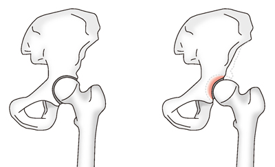 正常な股関節と寛骨臼形成不全