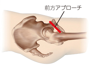 前方アプローチ