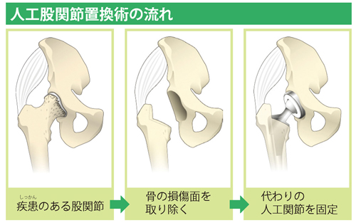 人工股関節置換術の流れ