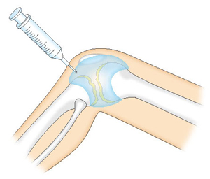 関節内への注射