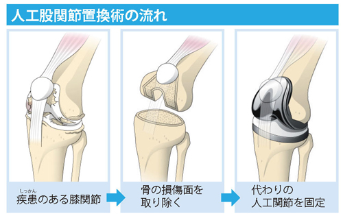 人工股関節置換術の流れ