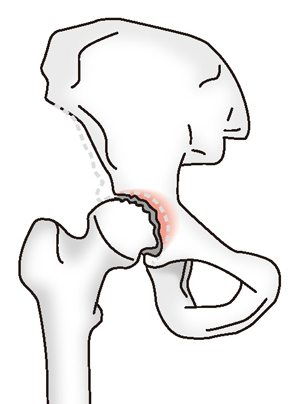 変形性股関節症