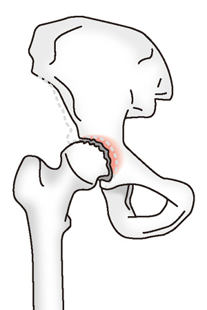 変形性股関節症