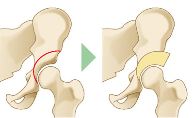 寛骨臼骨切り術