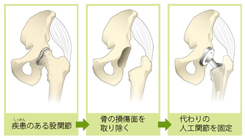 人工股関節置換術の流れ