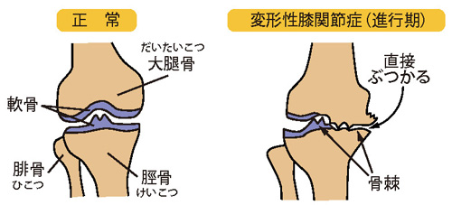 正常な膝と変形性膝関節症