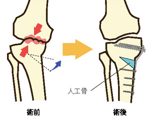 高位脛骨骨切り術