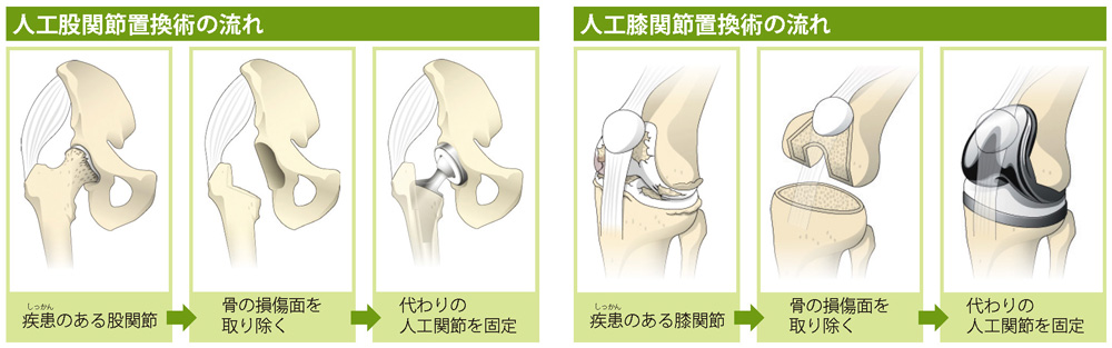 人工股関節置換術の流れ／人工膝関節置換術の流れ