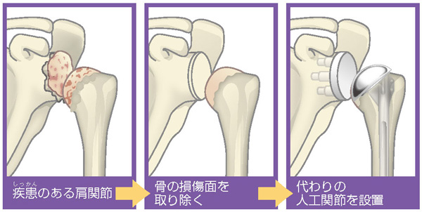 人工肩関節前置換術の流れ