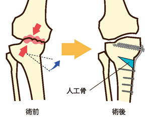 骨切り術