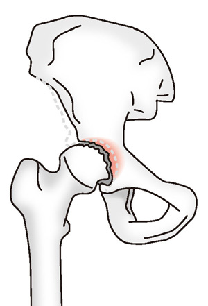 変形性股関節症