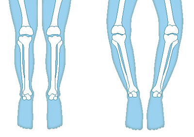 正常な膝関節／O脚