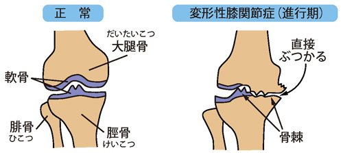 正常な状態と変形性膝関節症（進行期）
