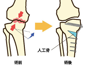 高位脛骨骨切り術