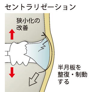 半月板内方化術（鏡視下セントラリゼーション）