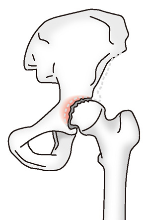 変形性股関節症