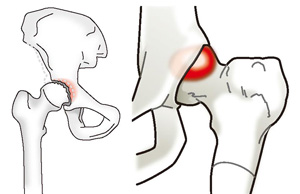 変形性股関節症と大腿骨寛骨臼インピンジメント