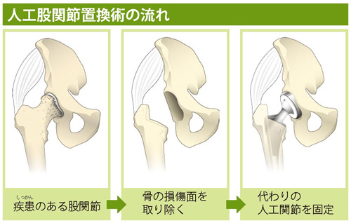 人工股関節置換術の流れ