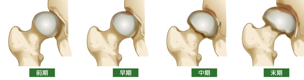 変形性股関節症の進行