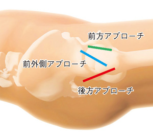 前方アプローチ／前外側アプローチ／後方アプローチ