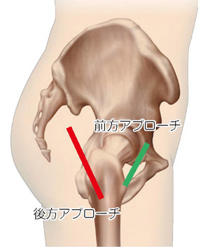 前方アプローチと後方アプローチ